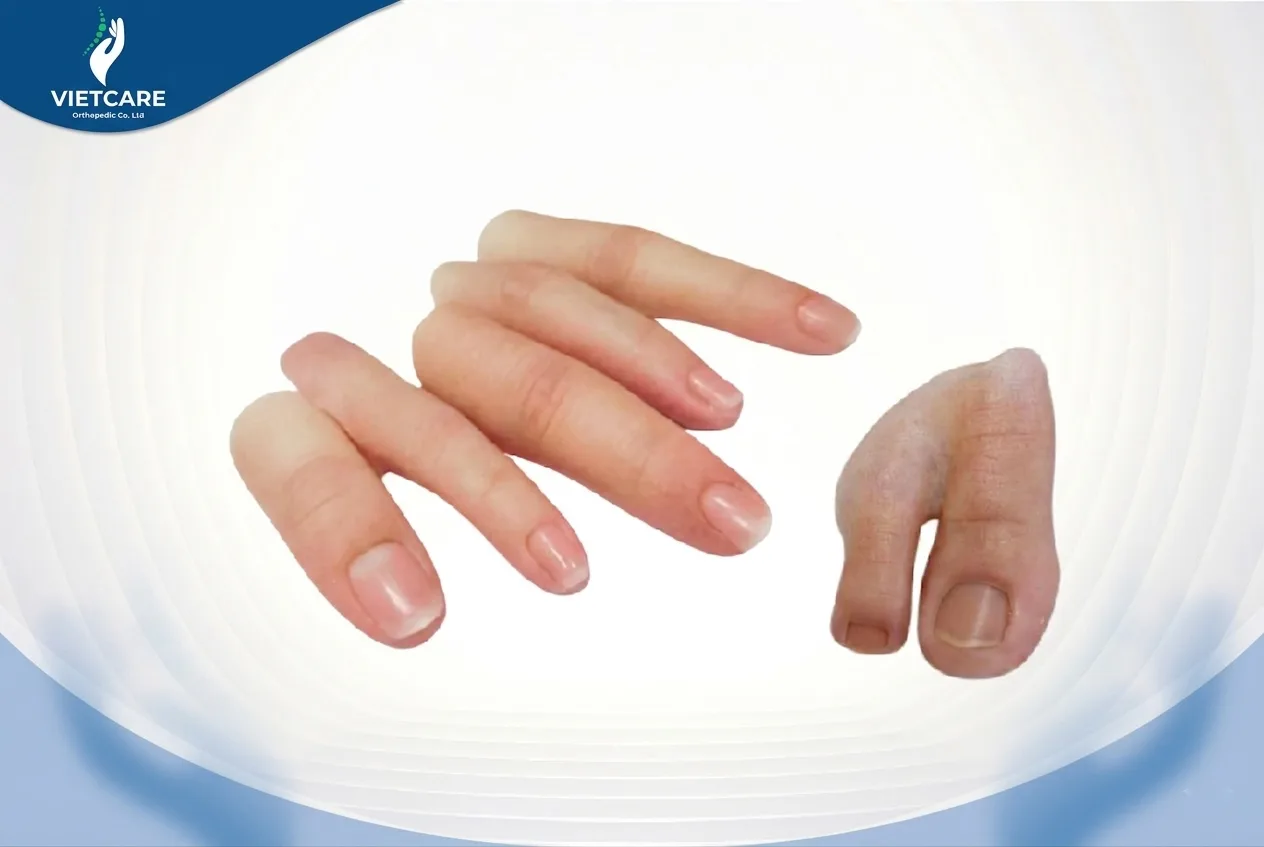 Ngón tay - Ngón chân thẩm mỹ