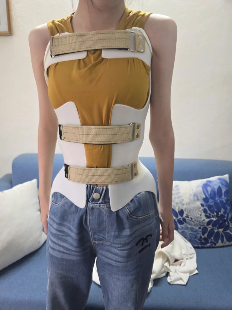 Áo chỉnh hình cột sống 3D – giải pháp hỗ trợ điều trị cong vẹo cột sống