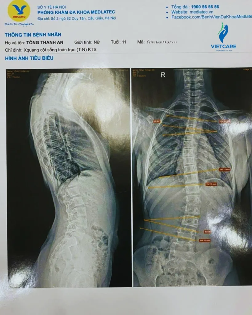 HÀNH TRÌNH CHỈNH VẸO CỘT SỐNG CHO BÉ 11 TUỔI: KHI “THỜI ĐIỂM VÀNG” QUYẾT ĐỊNH TƯƠNG LAI